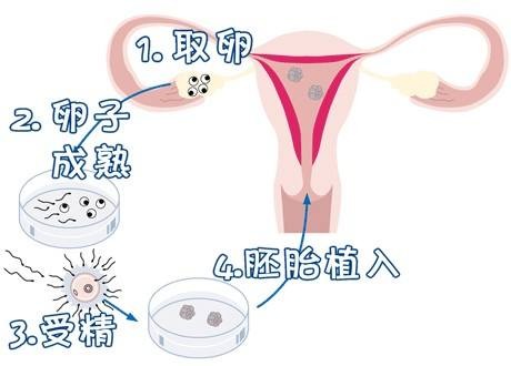 人工孕妈供卵服务怎么预约生殖中心
